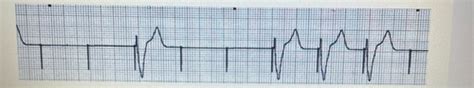 Ekg strips Flashcards | Quizlet