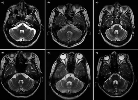 Cerebral Peduncle Mri