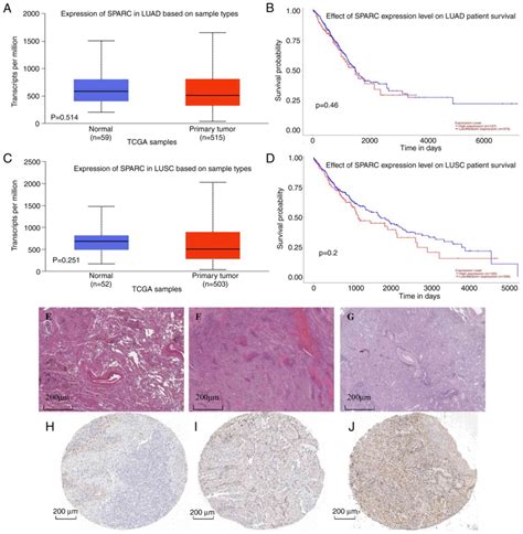 Prognostic significance of SPARC expression in non‑small cell lung cancer: A meta‑analysis and ...