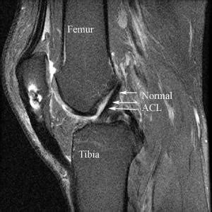 ACL Surgery and Reconstruction in Illinois | Dr. Roger Chams