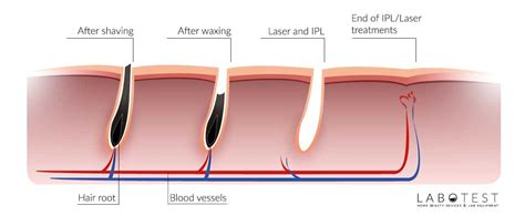 Hair-removal-vs waxing | LaboTest UK