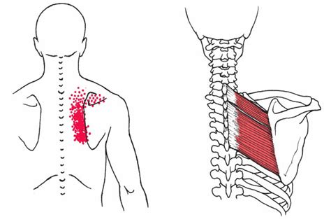 Rhomboid Muscle Pain | How To Fix Pain In Shoulder Blade