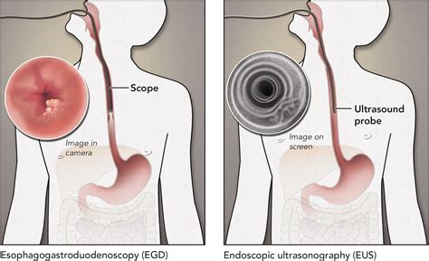 Evelyn Pence - Esophagectomy