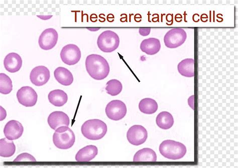 Codocyte Red blood cell Blood film Poikilocytosis, cavernous cell, purple, violet png | PNGEgg