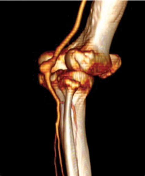 Popliteal Artery Aneurysm Repair in the Endovascular Era: Fo... : Medicine