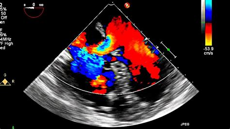 Atrial Septal Defect Primum Echocardiography - YouTube