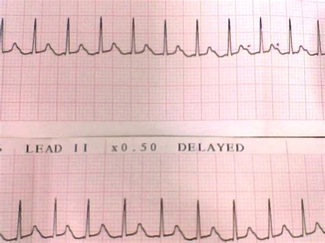 Cardiomegaly: Symptoms, Types, Diagnosis, Treating - 1401 Words | Research Paper Example