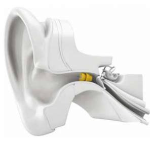 Lyric Extended-Wear Hearing Aid | Hearing Associates of Las Vegas