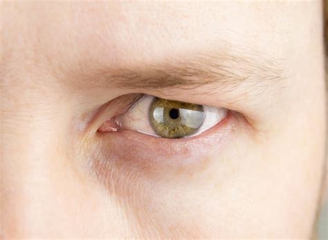 Droopy Eyelid: Causes, Symptoms, And Treatment Of Ptosis
