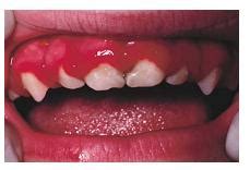 PDQ ORAL DISEASE: Herpetic Stomatitis: Primary