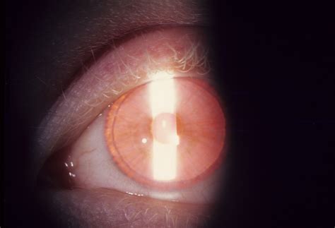 Albinism, Oculocutaneous, Type I | Hereditary Ocular Diseases