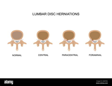 Central disc protrusion Cut Out Stock Images & Pictures - Alamy