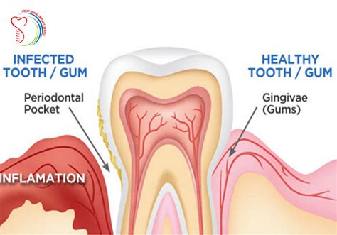 HOW TO TREAT LOOSE TEETH