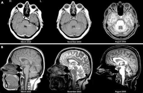 Clinical insights into paraneoplastic cerebellar degeneration | Journal of Neurology ...