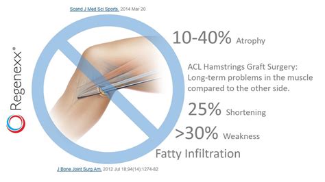 hamstring ACL surgery complications