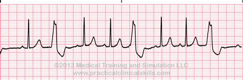 Complejo Ventricular Prematuro: Trigeminismo Guida de r