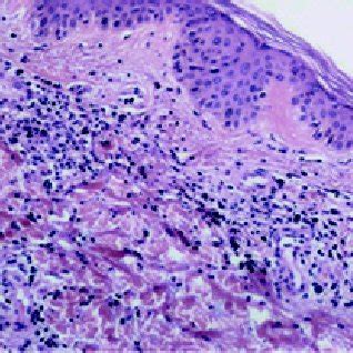 Causes of small vessel vasculitis. | Download Table