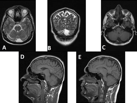 Is it an arachnoid cyst or a mega cisterna magna? What to and where to ...