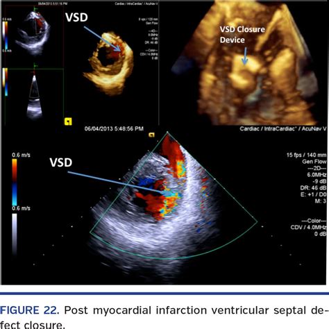 Real-Time Three-Dimensional Intracardiac Echocardiography: An Early Single-Center Experience