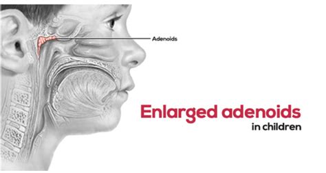 Enlarged Adenoids In Children: Find The Facts! - Too Kind Studio