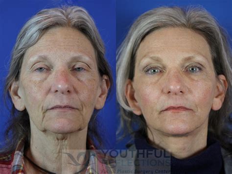 Facelift / Reflection Lift Before & After Photos Patient 31 | Nashville ...