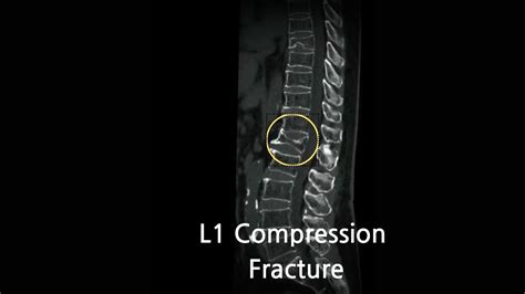 L1 (first Lumbar Body) Compression Fracture: Causes, Symptoms, And Treatment - YouTube