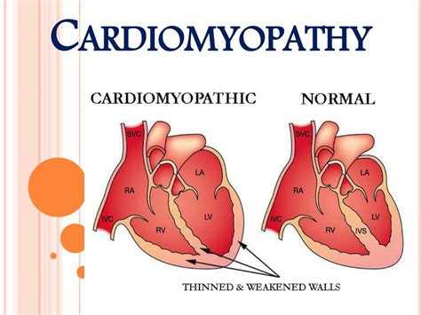 PPT - Heart Muscle Disease (Cardiomyopathy) PowerPoint Presentation ...