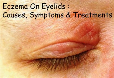 Eczema On Eyelids : Causes, Symptoms & Treatments | Disfreeskin