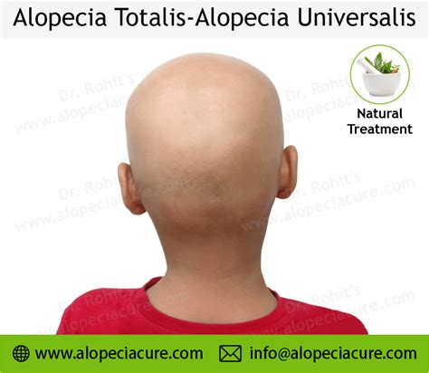 Alopecia Universalis