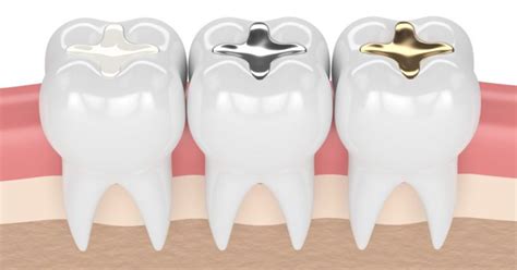 Comparing Filling Materials for Dental Fillings » Dentists In Rock Hill » India Hook Dental Care