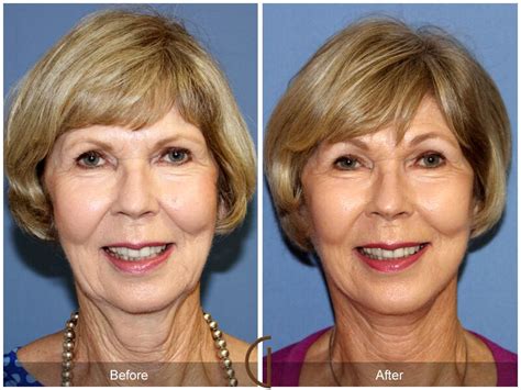 Neck Lift Before & After Photos From Dr. Kevin Sadati