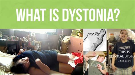 What Is Dystonia? Dystonia Awareness Week - YouTube