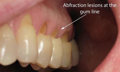 Tooth Abfraction Treatment