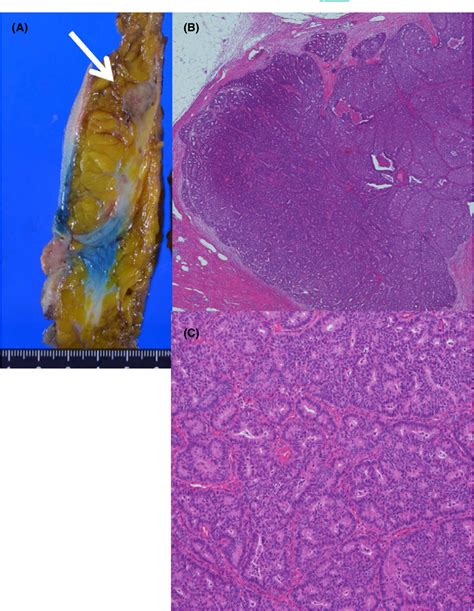 Figure 2 from Invasive cribriform carcinoma of the breast detected incidentally on computed ...