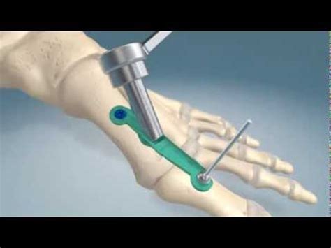 1st metatarsal-phalangel joint fusion procedure - YouTube