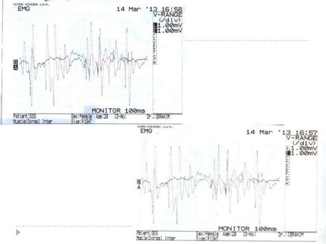 Syringomyelia ( Morvan syndrome) Electrodiagnosis