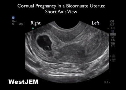 Emergency Ultrasound Identification of a Cornual Ectopic Pregnancy ...