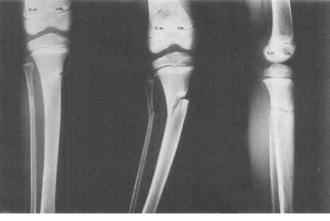 Figure 4 from Valgus deformity after fracture of the proximal tibial metaphysis in childhood ...