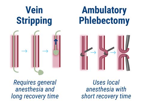 Veins Stripping VS Ambulatory Phlebectomy - Delaware Vein Center