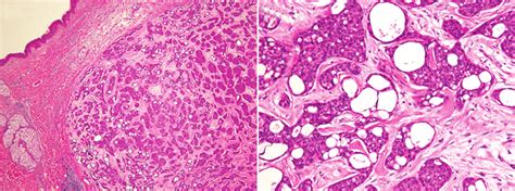 Histopathologic features of the primary cutaneous cribriform apocrine... | Download Scientific ...