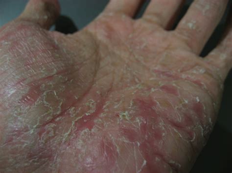 Eczema, Dyshidrotic; Eczema, Vesicular Palmoplantar; Pompholyx; Vesicular Palmoplantar Eczema