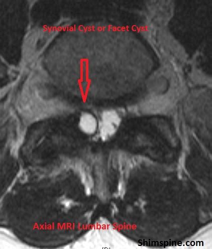 Synovial Cyst Lumbar Spine Removal - mapametawan