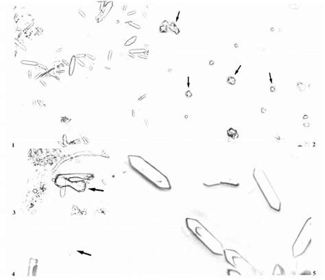 Calcium oxalate monohydrate crystals in urine of ethylene... | Download ...