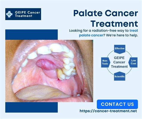 Soft Palate Vs Hard Palate Cancer! What Are the Differences | by Cancer Treatment Blog | Medium