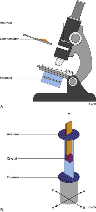 Synovial Fluid Crystal Analysis | Musculoskeletal Key