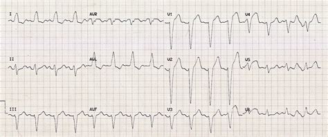 Left Bundle Branch Block (LBBB) • LITFL • ECG Library Diagnosis