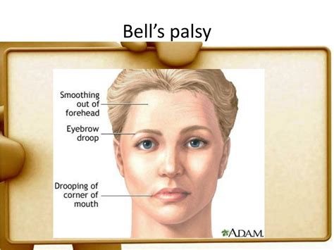 PPT - Bell’s Palsy PowerPoint Presentation, free download - ID:2184905