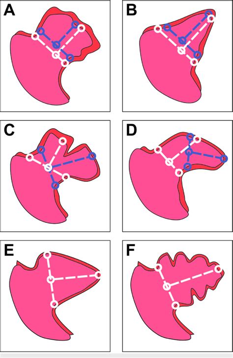 Left atrial appendage morphology and measurement error (A) Cauliflower... | Download Scientific ...