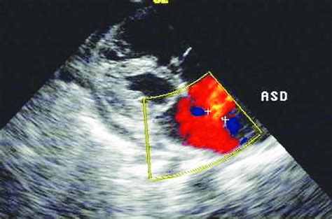 2D echocardiography showing atrial septal defect of size 12.1 mm ...