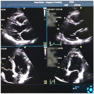 2D ECHOCARDIOGRAM (2D ECHO) TEST IN BANGALORE - Best Doctors in ...